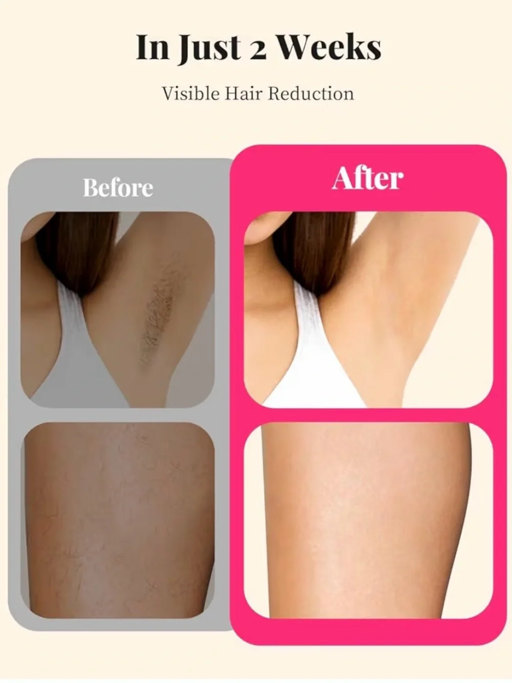 Laser Hair Removal for Women and Men